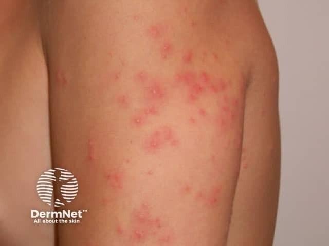 Fotoet viser utslett på overarm hos en person med svømmekløe