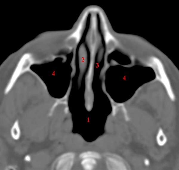Maxillarsinus, axial