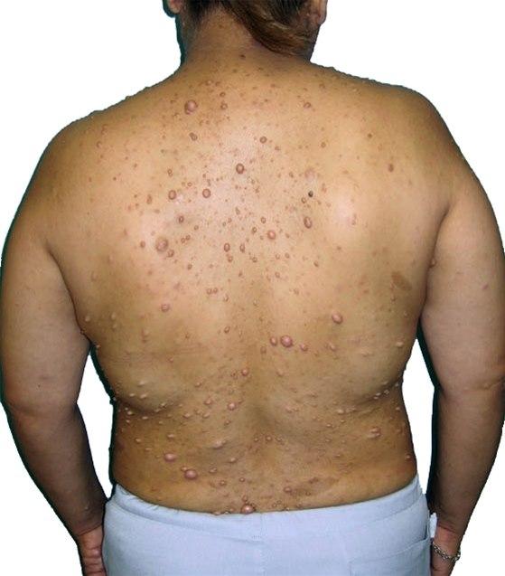 Nevrofibromatose