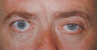 Horners syndrome