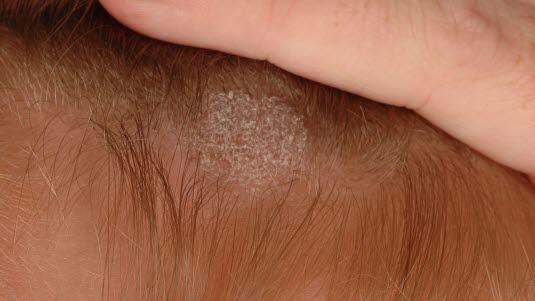 Tinea capitis