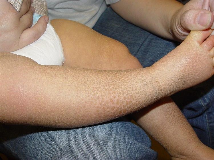 Ichtyosis vulgaris