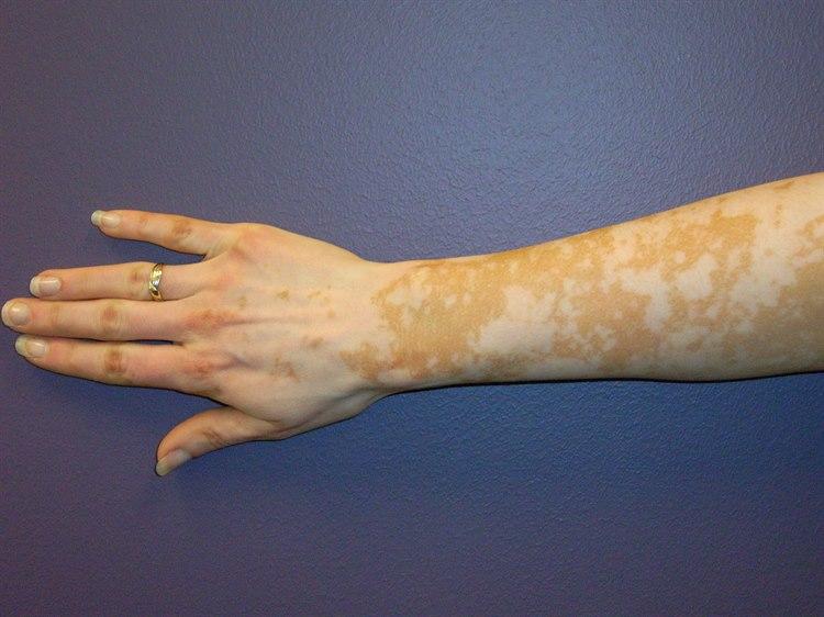 Vitiligo