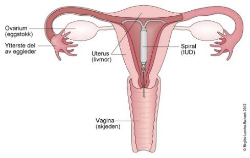 intrauteral device