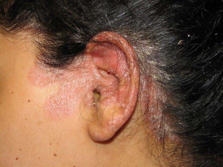Psoriasis, hodebunn