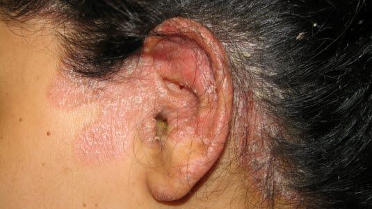 Psoriasis, hodebunn