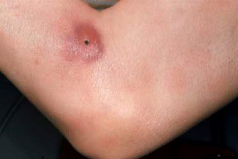 Mycosis fungoides 2