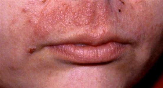 contact dermatitis