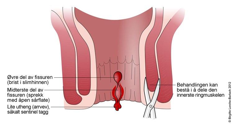 Analfissur
