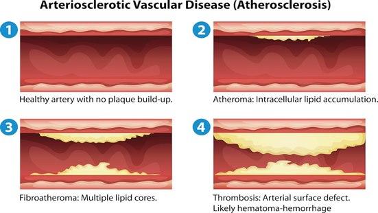 Tegninger av ulike grader av arteriosklerose
