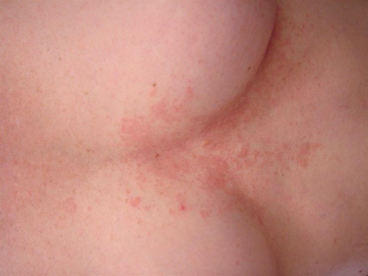 Seboréisk dermatitt