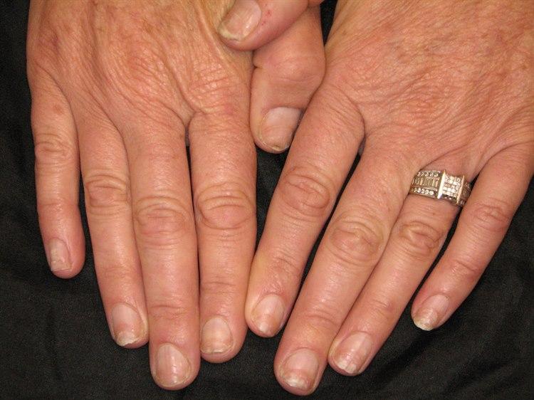 Negleforandringer ved psoriasis