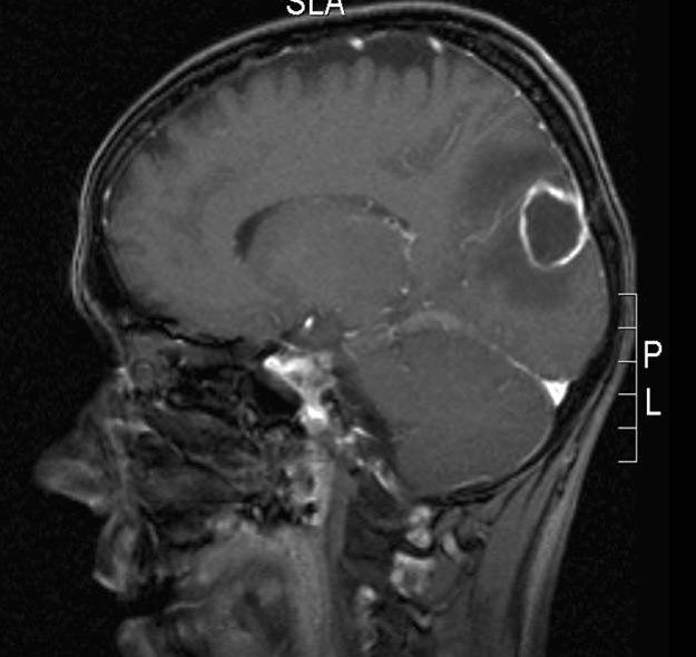 hjerneabscess 2
