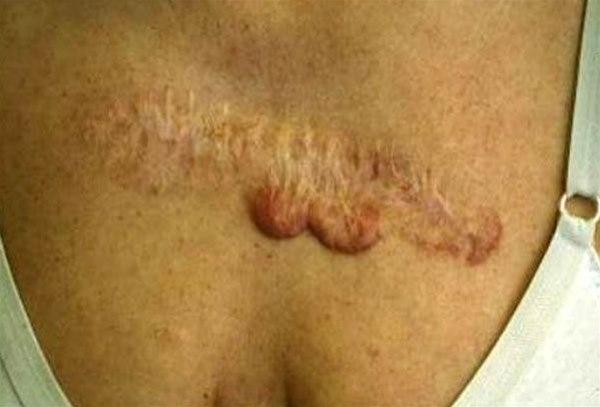 Keloid i arr etter fjerning av nevus på thorax.
