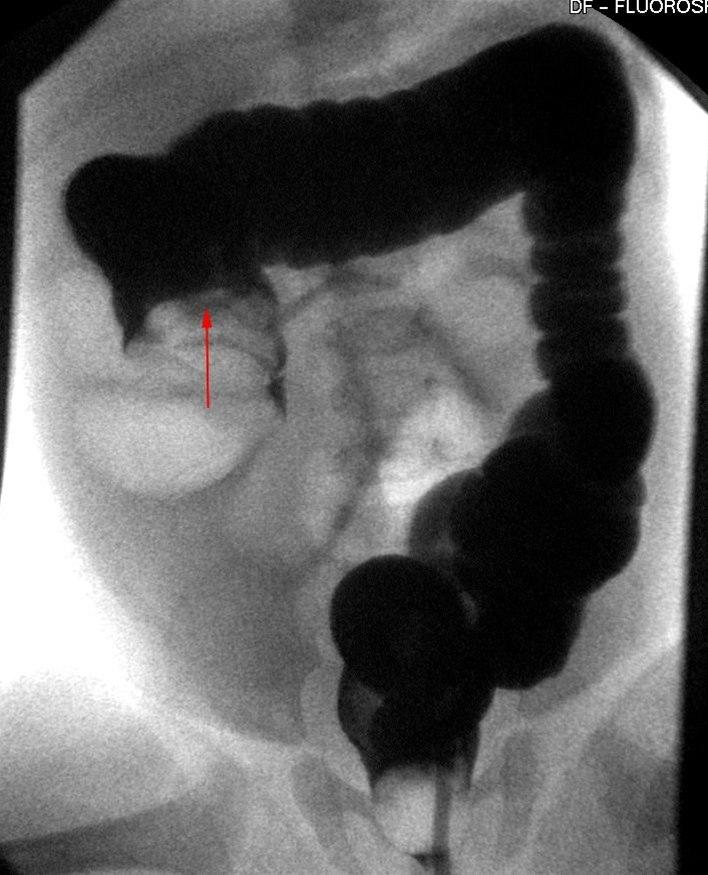 Colon-invaginasjon