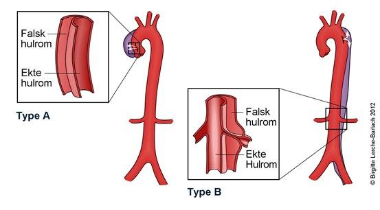 Aorta disseksjon
