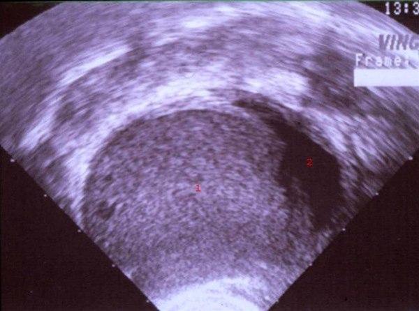 Endometriom