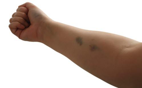 underarm