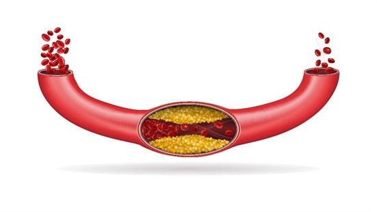 Arteriestenose