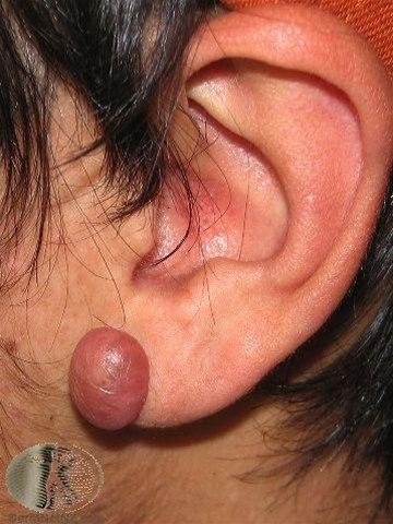 Fotoet viser keloid på et øre