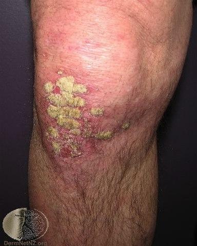 4176-2-psoriasis-kne