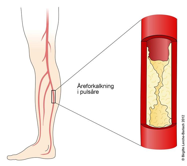 Aterosklerose