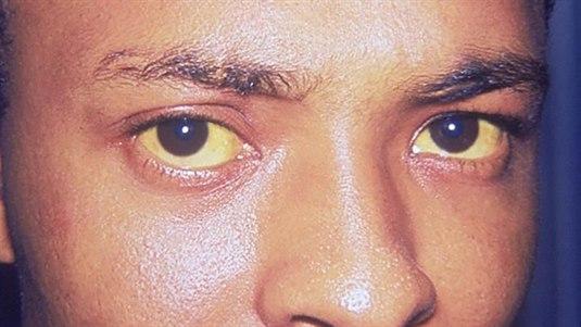 Jaundice, icterus