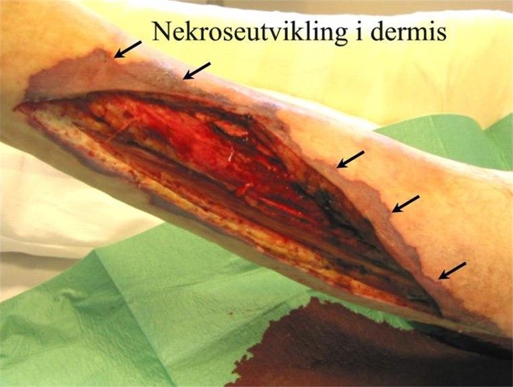 Nekroseutvikling i dermis