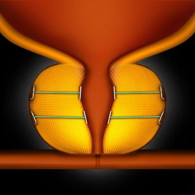 Urolift.jpg