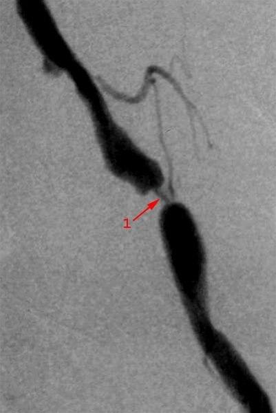 Bekkenarterie stenose