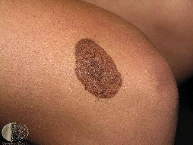 Fotoet viser nevus, medfødt