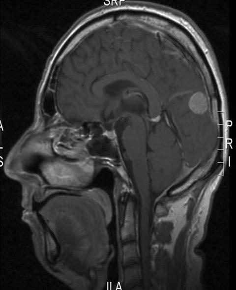 meningiom 2