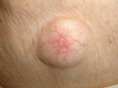 Epidermoid cyste lukket