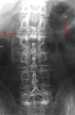 Columnafraktur frontalbilde
