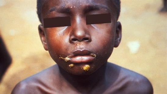 Afrikansk gutt med lesjoner på haken og munnvikene med frambøsi