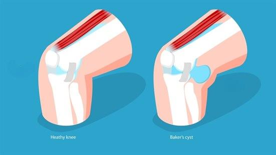 Illustrasjonen viser to knær med lår- og leggbenet, kneskål og mediale kollateralbånd tegnet inn. På venstre side av illustrasjonen vises det et friskt kne, og på høyre side et kne med Bakers cyste bakpå kneet.