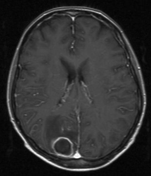 hjerneabscess 1