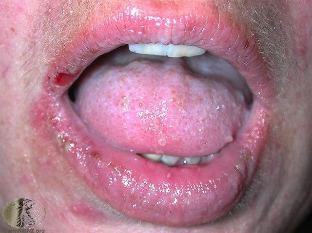 Fotoet viser pemfigus vulgaris
