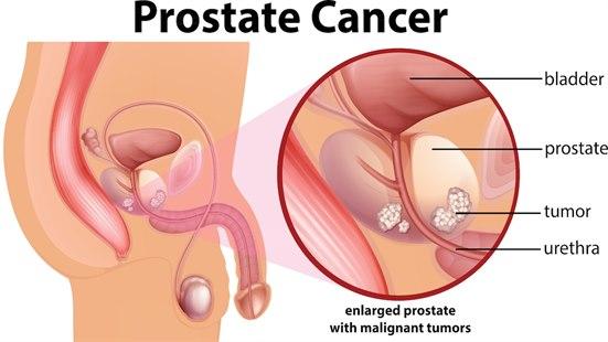 Prostatakreft
