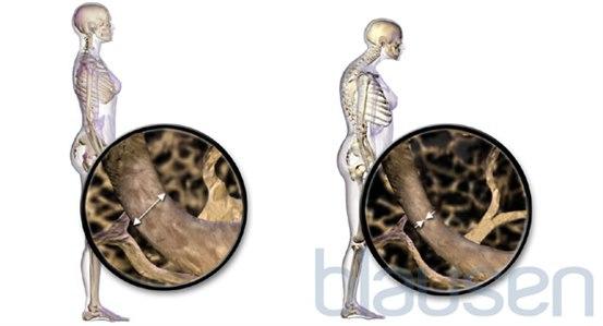 Osteoporosis 
