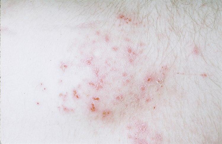 Dermatitis herpetiformis