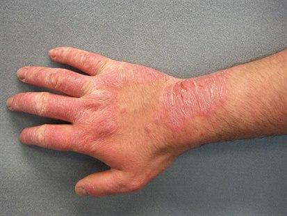 Contact dermatitis (rubber)