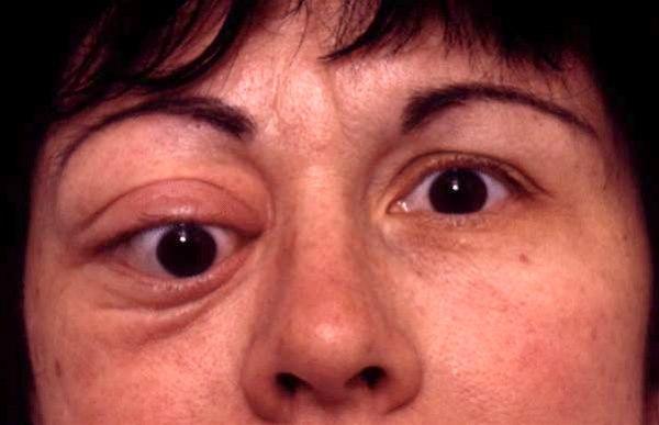Tumor orbita