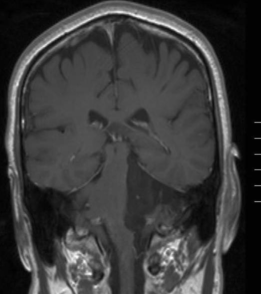 epidermoid tumor 1