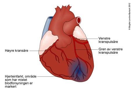 Hjerte med infarkt