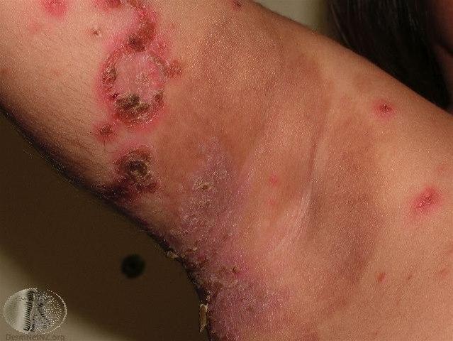 Fotoet viser impetigo (brennkopper)