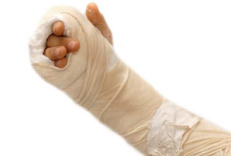 Brukket arm med gips
