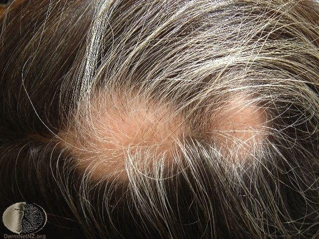Fotoet viser alopesia, gjenvekst