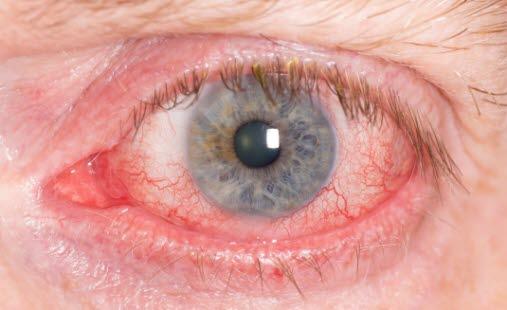 Red eye