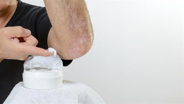Psoriasis